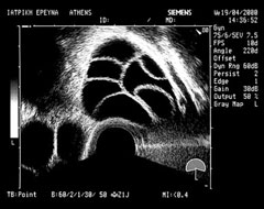 Multiple follicle development. The follicles have matured (transvaginal ultrasound) (EUGONIA archive).